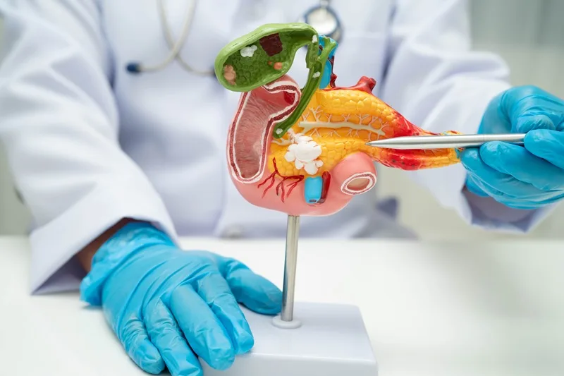 Cáncer de páncreas